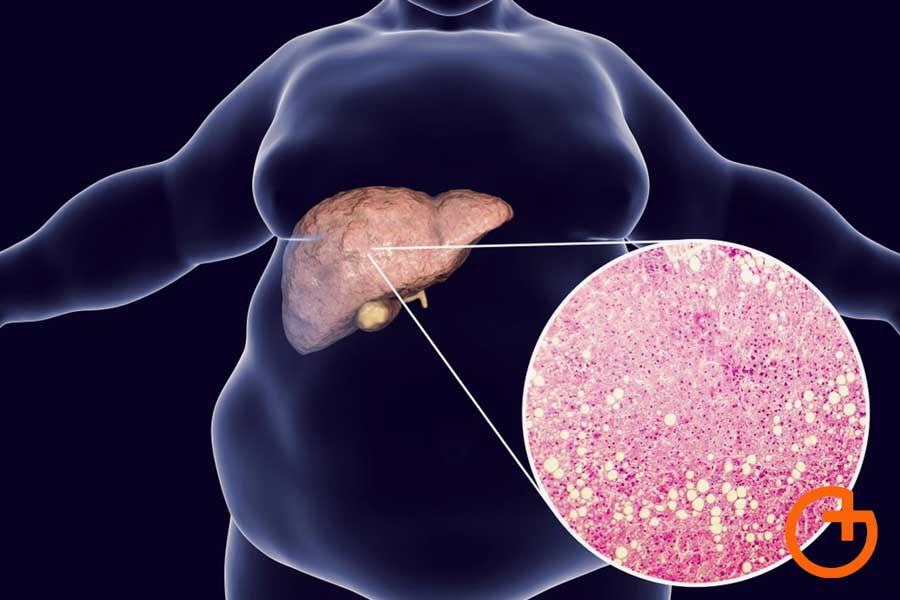 hígado graso también conocido como esteatosis hepática